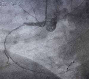 Una arteria obstruida puede derivar en un infarto de miocardio. fotos: Grupo Policlínica