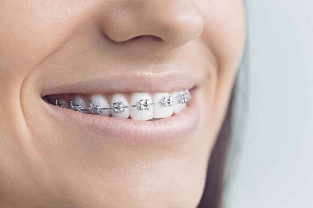 Era muy común jugar a combinar los colores de las gomas de los ‘brackets’. foto: istock