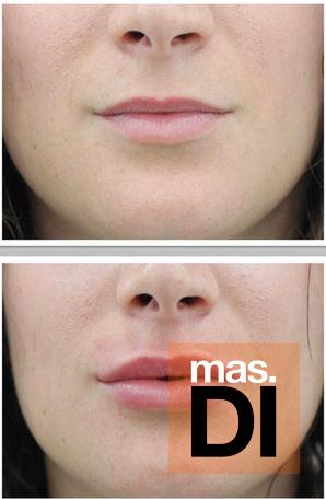 Relleno de labios con ácido hialurónico, rápido y natural en Eiviestetic