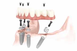 Poner fin a las molestas prótesis dentales con el sistema All on 4® | másDI - Magazine